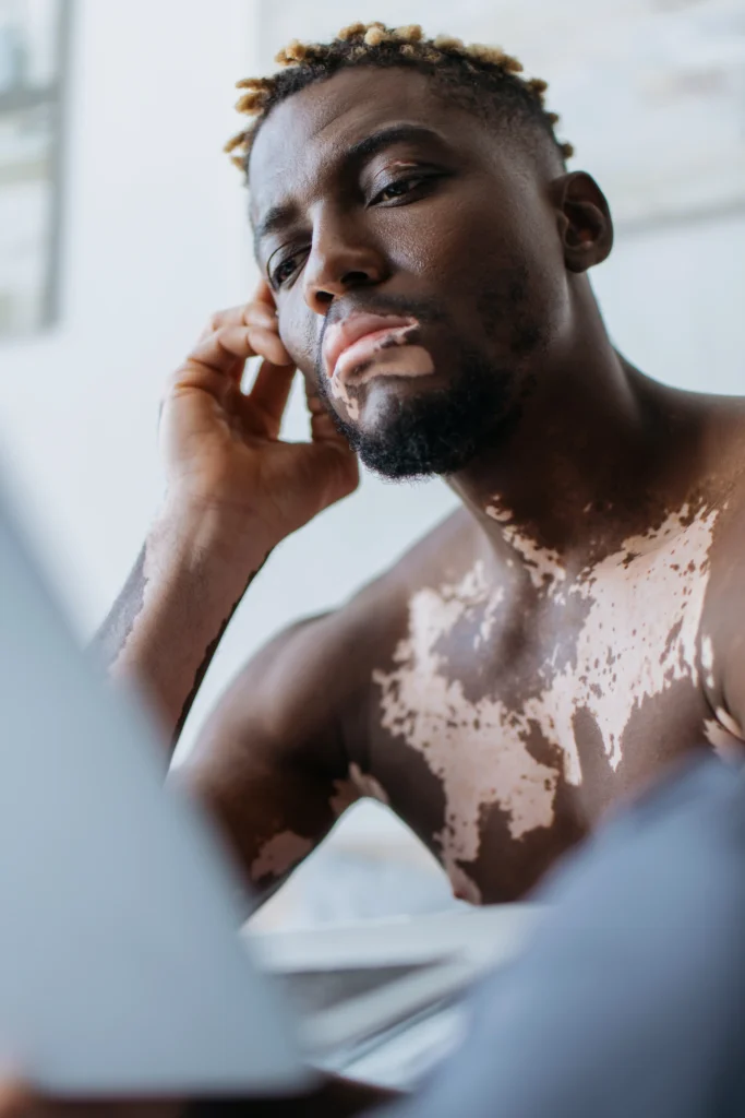 A Black man with vitiligo on his face, lips, and upper chest looks slightly away from the camera, resting his chin on his hand. He has short, styled dreadlocks and a light beard.