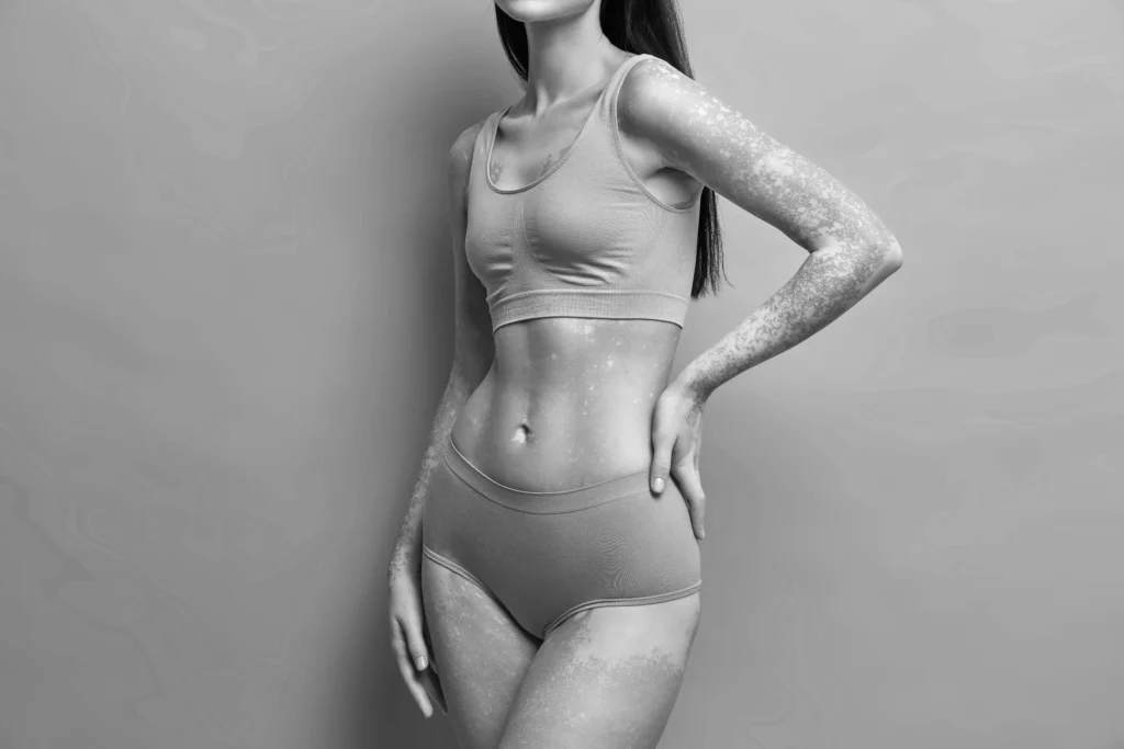 A black and white full body shot of a slender woman with vitiligo patches visible on her arms, torso, and legs. She is wearing a two-piece athletic bra and underwear set, with her hands on her hips.