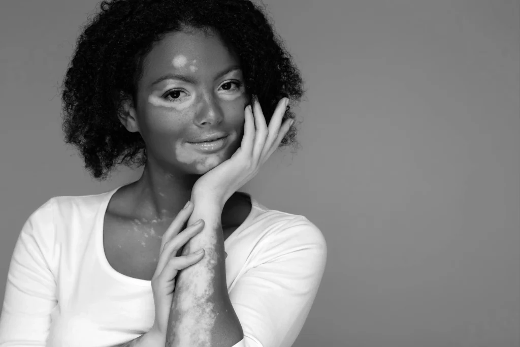 A black and white portrait of a young woman with vitiligo on her face, neck, and arms. She has curly hair and is smiling softly while resting her chin on her hand, her other hand clasped over it. She is wearing a light-colored top.