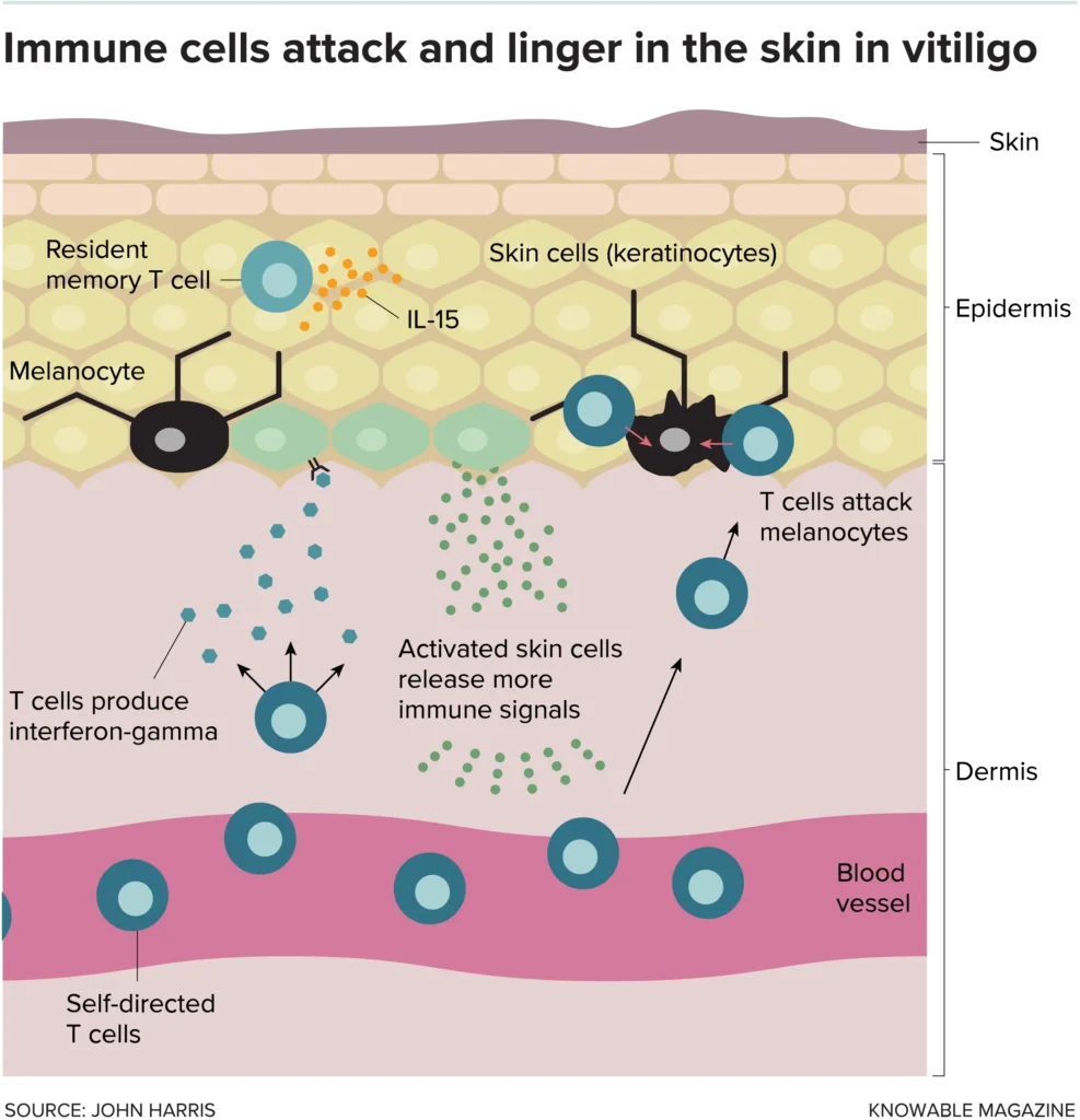 A scientific diagram illustrating how immune cells attack melanocytes in the skin in vitiligo. The diagram shows resident memory T cells and keratinocytes releasing IL-15, activated skin cells releasing more immune signals, and T cells attacking melanocytes. Self-directed T cells are shown originating from a blood vessel and also producing interferon-gamma.